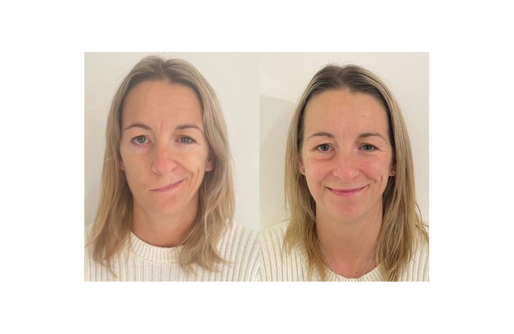 CACI Synergy treatments prove successful in treating Bell’s Palsy Client